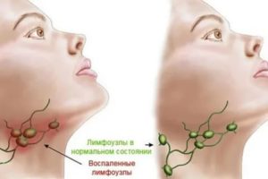 Могут ли у здорового человека прощупываться лимфоузлы?