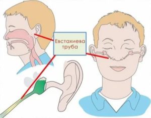 Шум в и заложенность уха при гайморите