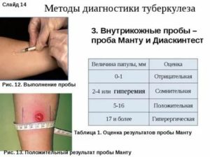 Заболел после диаскинтеста