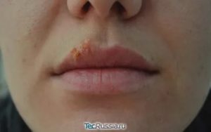 Процедура увеличения губ при герпесе