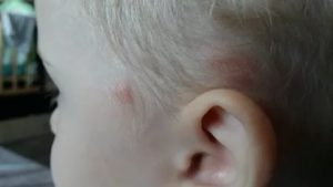 Шишка над ухом у ребенка
