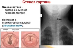 У ребенка часто случается стеноз гортани