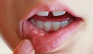 Трещины на слизистой рта