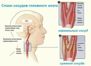 Спазм сосудов шеи при беременности