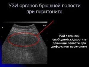 Можно ли на узи увидеть перитонит?