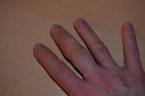Болит и распухла рука после укола шипом растения