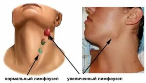 Увеличен подчелюстной лимфоузел, субфебрильная температура