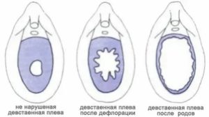 Вопрос по безболезненной дефлорации