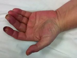 Онемение пальца после пореза
