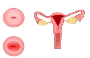 Задержка менструации и эрозия шейки матки