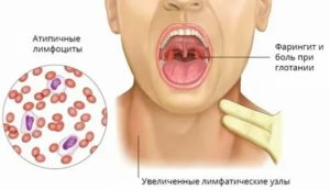 У ребенка нашли вирус Эпштейна-Барр