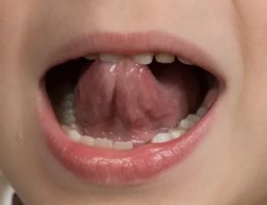 Сыпь под языком