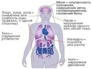 Онемение руки, спутанность речи