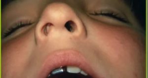 Ребенок поцарапал ногтем слизистую носа