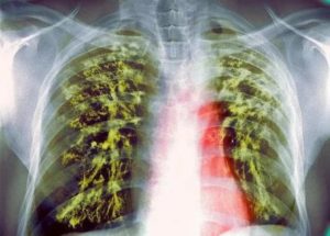 Может ли активная форма туберкулеза протекать без симптомов?