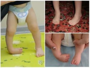 Ребенок 2,5 года стал косолапить на одну ногу