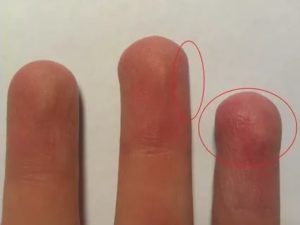 Болят пальцы и подушечки пальцев
