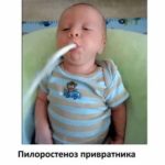 Субфебрильная температура у ребенка
