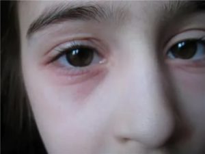 Красная опухшая складка под глазом у ребенка