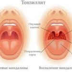 Болит горло, коричневый налет на языке