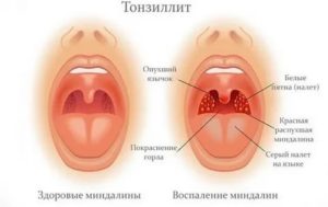 Першение в горле после ангины