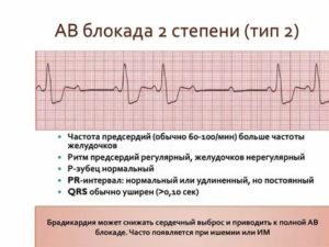 Может ли пройти АВ блокада 2 степени?