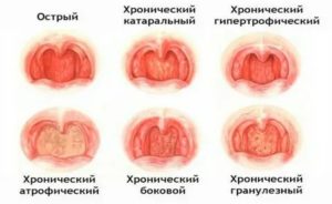 Фарингит, красное горло, увеличены лимфоузлы