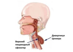 Застряла в горле таблетка, что делать?