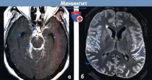 Подозрения на менингит на основе МРТ, симптомов нет