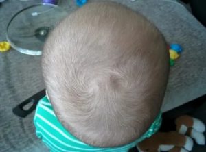 Бугры на голове у ребенка