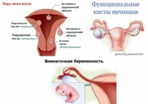 Задержка менструации, увеличена матка