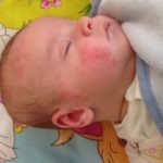 Может ли ребенок заразиться молочницей от другого ребенка?